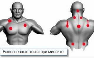 Как лечат миозит грудной клетки