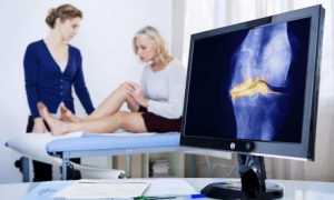Что такое супрапателлярный бурсит коленного сустава и как его лечить