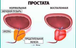 Классификация разновидностей простатита