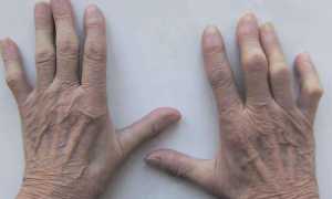 Как лечить околосуставной остеопороз кистей рук