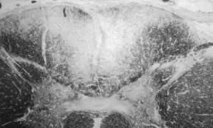 Что такое сухотка спинного мозга и как её лечить
