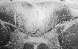 Что такое сухотка спинного мозга и как её лечить
