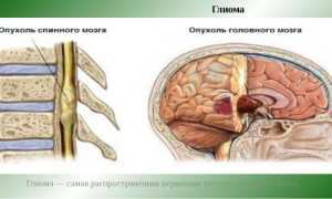 Как лечить рак спинного мозга