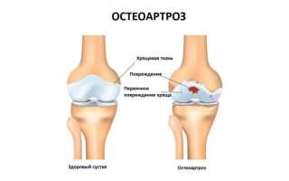 Как лечить остеоартроз кистей рук и локтевого сустава