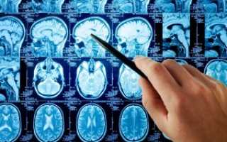 Назначение, процедура и заключение МРТ головного мозга