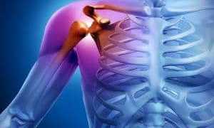 Как проходит эндопротезирование плечевого сустава