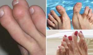 Как лечат молоткообразные пальцы на ногах