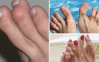 Как лечат молоткообразные пальцы на ногах