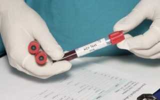 Анализы крови на ВИЧ: подготовка, процедура и сроки