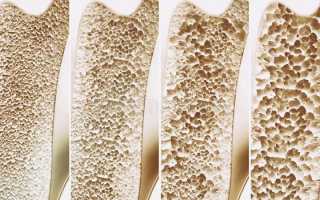 Что такое диффузный остеопороз