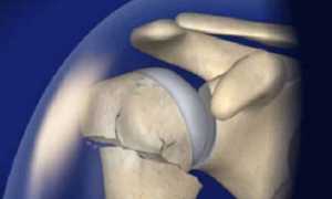 Как лечить перелом шейки плеча