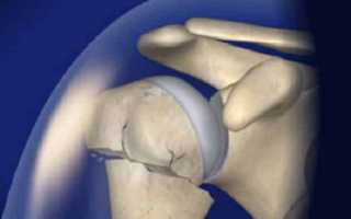 Как лечить перелом шейки плеча