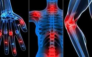 Что такое артрит и как его лечить