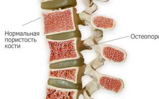 Как лечить патологический перелом позвоночника