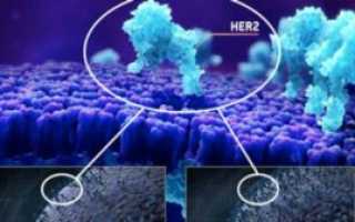 HER2-положительный рак молочной железы: диагностика и методы определения her2 статуса