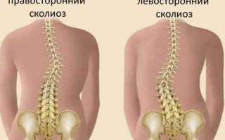 Как лечить левосторонний сколиоз