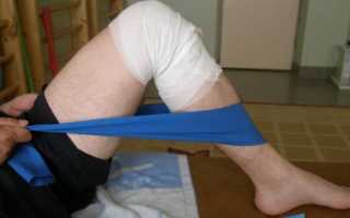 Как лечить перелом мыщелка коленного сустава